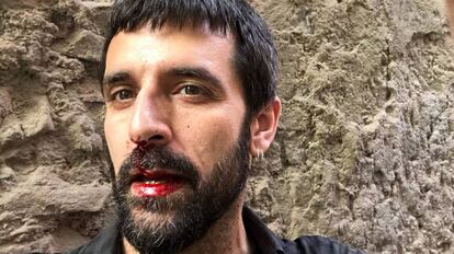 Jordi Borràs, després de l'agressió