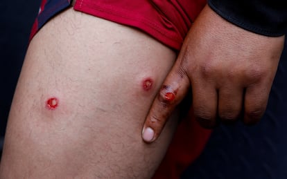 Un hombre muestra las heridas que ha recibido durante la marcha.