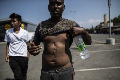 Uno de los refugiados en la isla griega muestra heridas en su abdomen.
