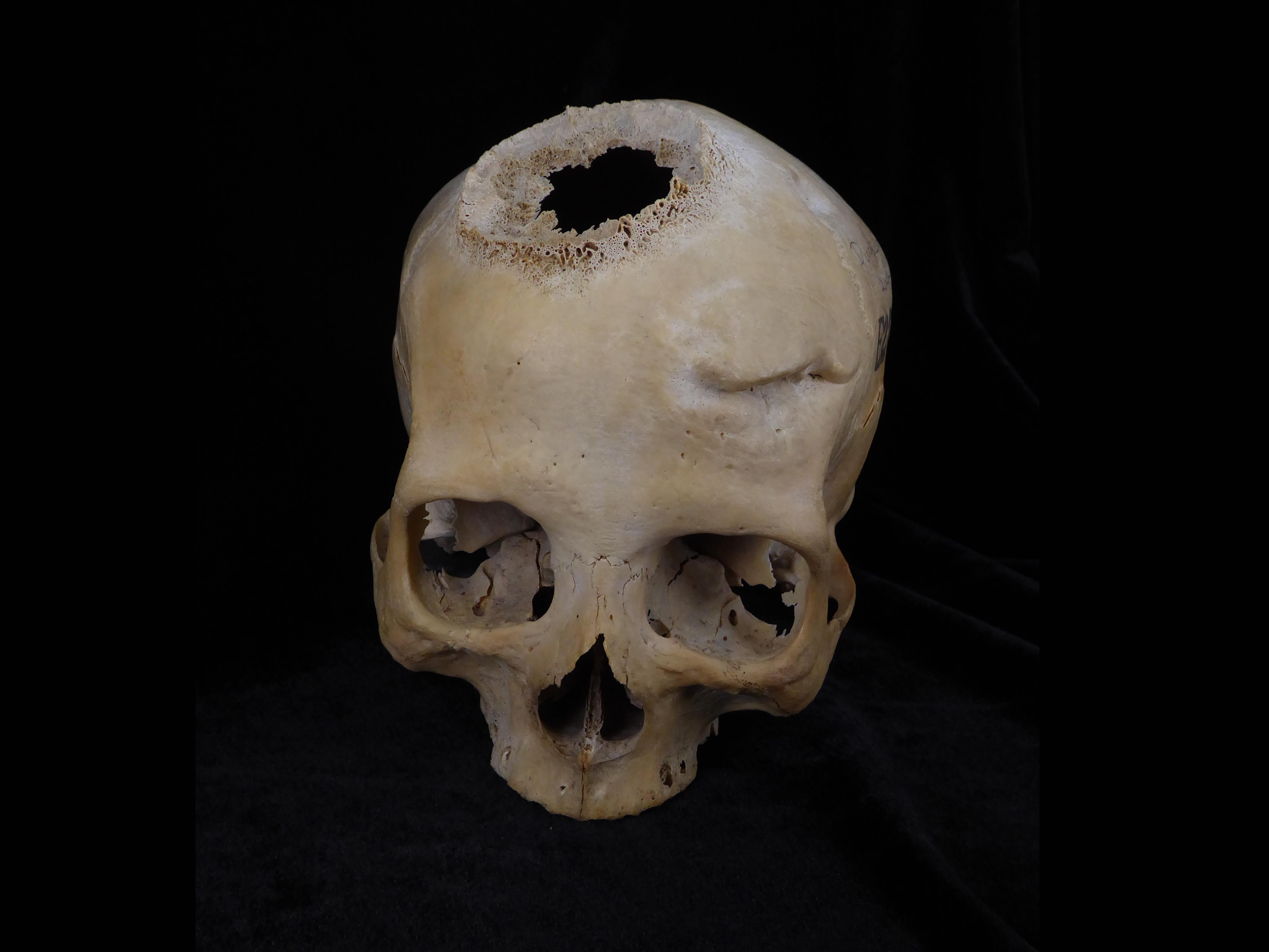 Researchers discover evidence of cancer surgery in skull from Ancient Egypt - Vimarsana News