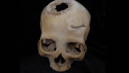 El cráneo de la mujer de 50 años, con una herida de espada cicatrizada.