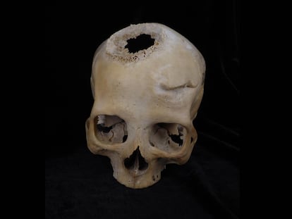 El cráneo de la mujer de 50 años, con una herida de espada cicatrizada por encima del ojo izquierdo y la cicatriz dejada por el tumor en la parte central.