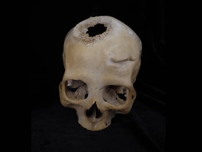 Crânio de mulher de 50 anos, com ferimento de espada cicatrizado acima do olho esquerdo e cicatriz deixada pelo tumor na parte central.