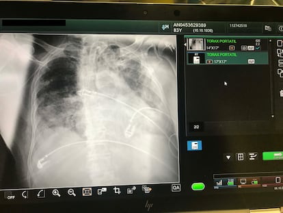 La consola de imagen radiológica Advance de Fujifilm consigue imágenes de alta calidad con una menor dosis de radiación.