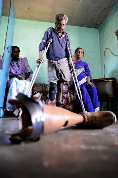 Raju, alcohólico, no toma la medicación como es debido, y por eso ha perdido ya una pierna. "Nos meten estos poblados y si morimos a nadie le importa", denuncia.