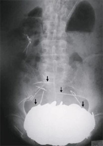 Radiografía de un paciente francés trasladado de urgencia al hospital con centenares de monedas en su estómago. El enfermo sufre un impulso irrefrenable a devorar metales.