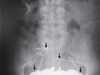 Radiografía de un paciente francés trasladado de urgencia al hospital con centenares de monedas en su estómago. El enfermo sufre un impulso irrefrenable a devorar metales.