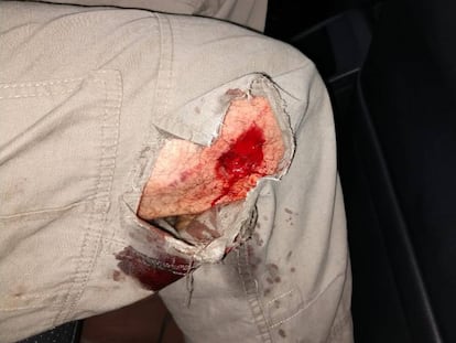 Daniel Arroyo foi atingido no joelho direito por uma bala de borracha 
