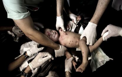 Personal sanitari atén a l'Hospital de Shifa una nena palestina ferida a Gaza després de l'ofensiva israeliana a la franja l'estiu de 2014, coneguda com Operació Marge Protector, en la qual durant gairebé dos mesos van morir 2.200 palestins, la majoria civils, i 74 israelians.