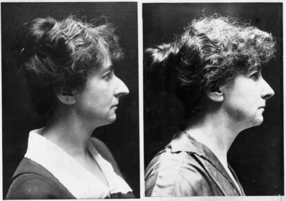 Una paciente del Dr Bourget, miembro de la Academia Francesa de Medicina, antes y despúes de someterse a una operación de cirugía plástica para enderezar el puente nasal, en 1924.