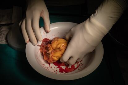 Vista del corazón dañado tras extraerlo de la paciente en el Hospital Clínic de Barcelona, en 2022.