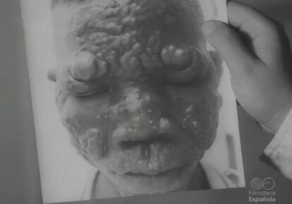 Imagen de un niño enfermo en la leprosería de Mikomeseng.