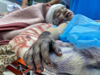 Un niño palestino, que resultó herido en un ataque israelí, yace en una cama en el hospital Shift en la ciudad de Gaza, este domingo.