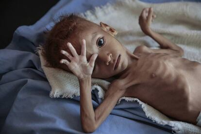 Niño víctima de malnutrición en Yemen, en un hospital de Hajjah en octubre.