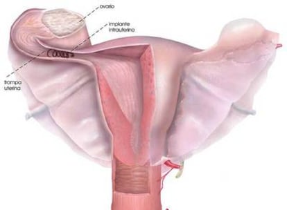 Esquema de la ubicación del dispositivo de esterilización en la trompa de Falopio.