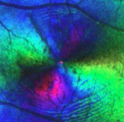 Graças às invenções de Land se generalizou o uso da luz polarizada para caracterizar tecidos e objetos, como nessa imagem colorida artificialmente da retina de um paciente com diabetes que revela estruturas irregulares causadas pelo edema.