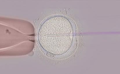 Técnica de fecundación in vitro de un óvulo donado.