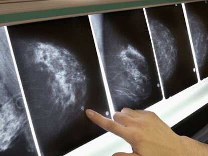 Mammograms of a breast tumor.