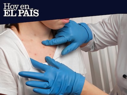 La vuelta del sarampión a España: “No puede reducirse todo a los ‘antivacunas”