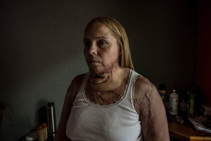 Karina Abregu (42) fue quemada por su marido, que es alcóholico, tras 11 años de violencia. Karina actualmente no puede trabajar debido a su salud y no recibe ningún tipo de ayuda por parte del gobierno. Karina lucha por sus derechos con la ayuda de su hermana Carolina.