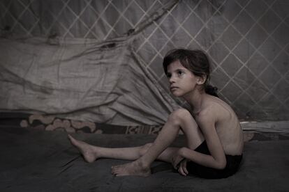 Lana Salih Juha, de cinco años, huyó con su familia de Gaza. Sufre desnutrición severa.