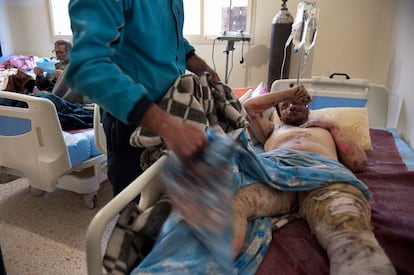 Varios civiles sirios son atendidos en 2013 en el hospital informal de Arsal de quemaduras graves tras un atentado con coche bomba en la ciudad siria de Rankus.