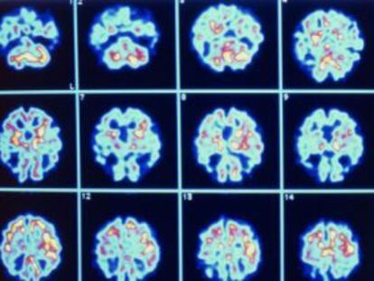 Deterioro de distintas partes del cerebro causado por el alzh&egrave;imer