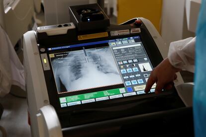 Radiografía de pulmón a un paciente con coronavirus en un hospital de París (Francia), el lunes.