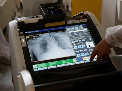 Radiografía de pulmón a un paciente con coronavirus en un hospital de París (Francia), el lunes.