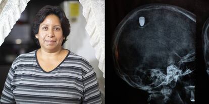 A la izquierda, Lourdes Gutiérrez. A la derecha, la radiografía del balazo.