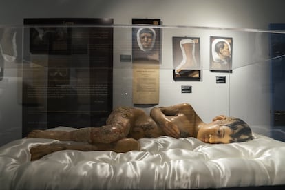 Wax figure of an 8-year-old girl with widespread ringworm who died in 1880, in the Olavide Museum in Madrid.