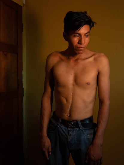 Nilo Vargas, 27, shows his scars. In 2010, in the community of Monte Salvado, a group of people in voluntary isolation attacked him with an arrow that pierced his abdomen.