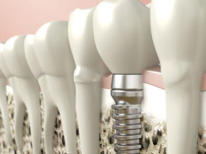 El implante, ¿en mi dentista o en una franquicia dental?