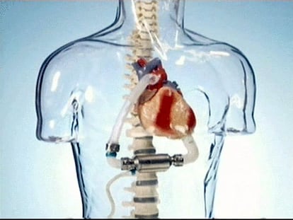 Una mujer recupera las funciones cardíacas en la primera implantación de corazón artificial en España