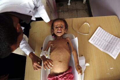 Una niña desnutrida se pesa mientras recibe tratamiento en un hospital, en Sana'a (Yemen).