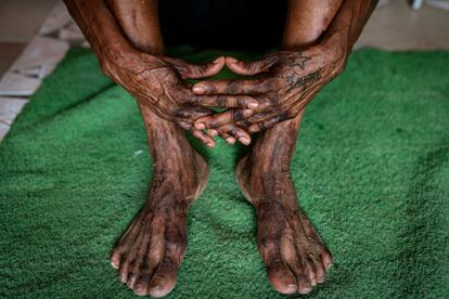 La senegalesa Seynabou Tine muestra sus manos y sus pies, visiblemente deteriorados por el uso durante años de productos blanqueadores.