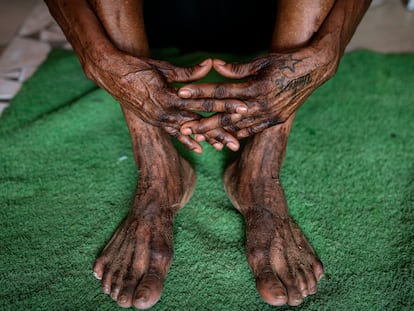 La senegalesa Seynabou Tine muestra sus manos y sus pies, visiblemente deteriorados por el uso durante años de productos blanqueadores.