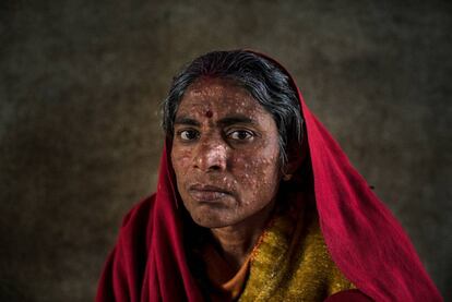 Una paciente de leishmaniasis en un hospital de MSF en Hajipur (India).