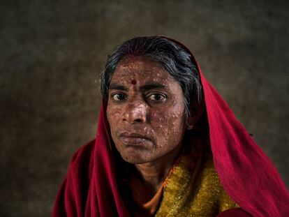 Una paciente de leishmaniasis en un hospital de MSF en Hajipur (India).