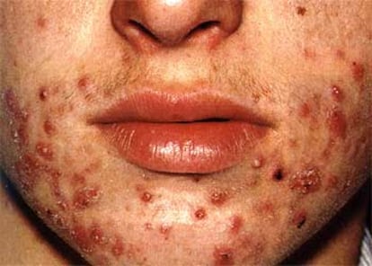 Cara de un joven con la piel afectada por pústulas de acné.
