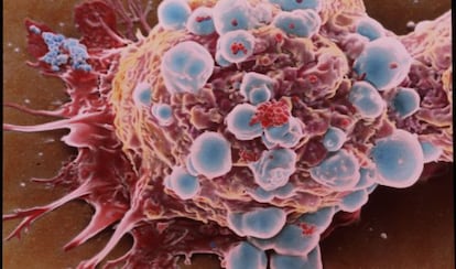 Microfotograf&iacute;a coloreada de c&eacute;lulas de c&aacute;ncer de mama.