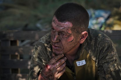 Un militar herido con quemaduras en el rostro, las manos y otras partes del cuerpo durante un ataque con un misil ruso espera a ser atendido.