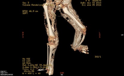 A scan of Cayetana’s legs, taken in 2016, showing the transformation of muscle into bone.