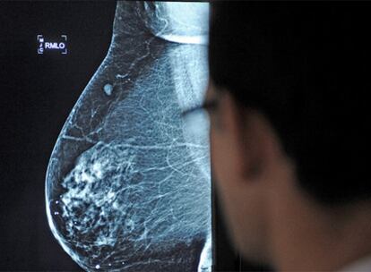 Un médico observa la radiografía de una mama.