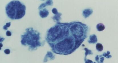 En la imagen aparece la mutación del virus varicela zóster y el herpes zóster. El segundo suele afectar a los adultos de 50 años.