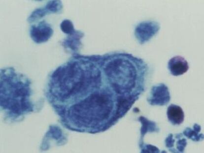 En la imagen aparece la mutación del virus varicela zóster y el herpes zóster. El segundo suele afectar a los adultos de 50 años.