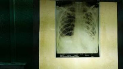 Radiografía de un paciente de tuberculosis.