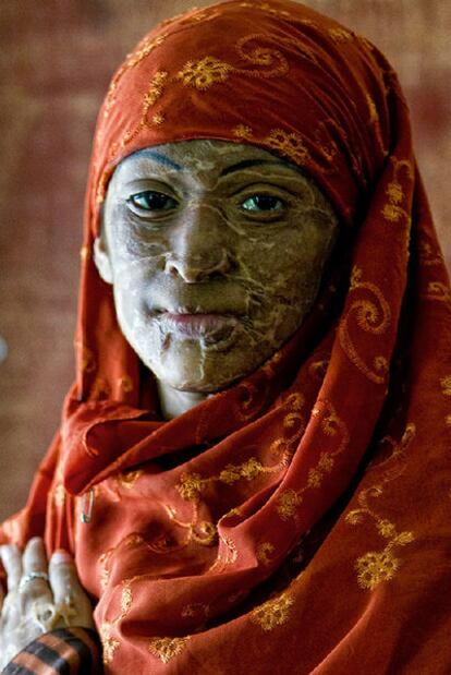 Nila, 17 años, fue quemada con ácido por su esposo en Bangaldesh cuando tenía 13 años.