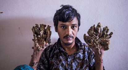 Abul Bajandar, 'El hombre árbol', en el Hospital de Dhaka, Bangladés. 