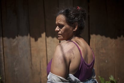 Gregoria Fernández, una de las madres de familia de Guahory (Paraguay), muestra las heridas de los golpes de la Policía al día siguiente del desalojo.